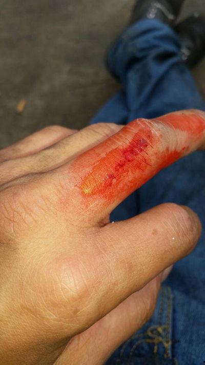 手出血的图片,手部出血紧急处理与预防指南